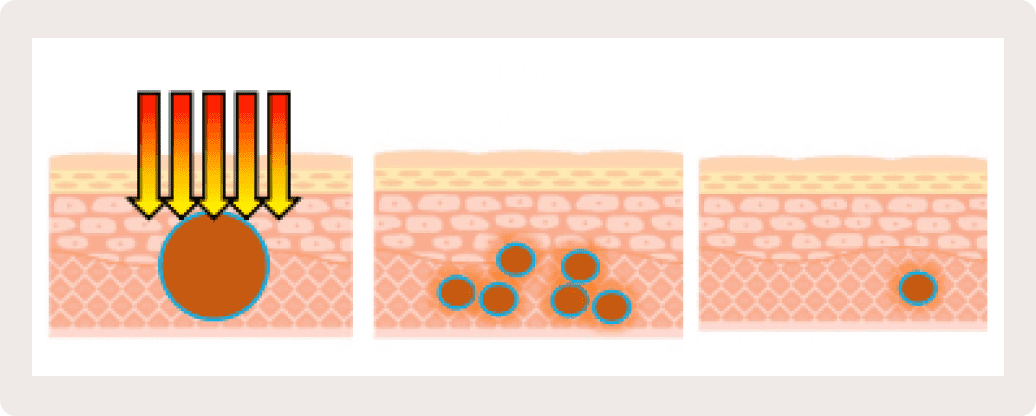 レーザーの照射で皮膚に微小な穴をあける