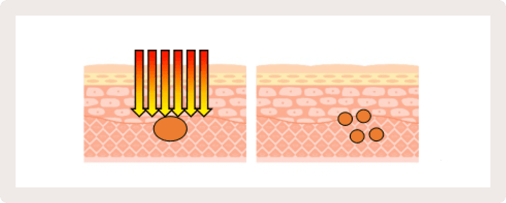 レーザーの照射で皮膚に微小な穴をあける
