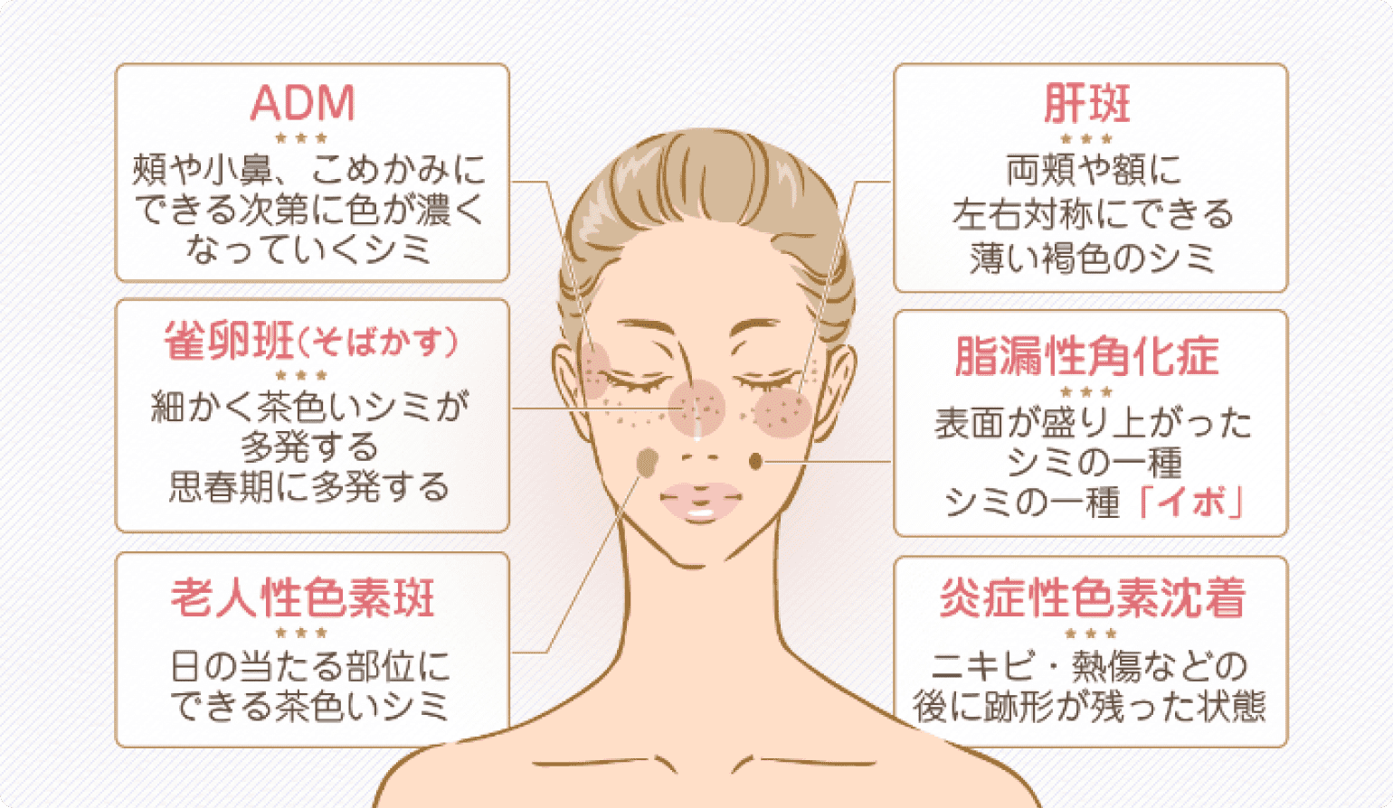 シミの種類