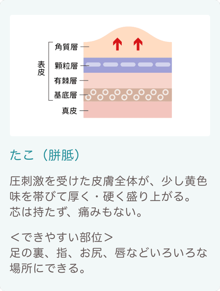 たこ・魚の目