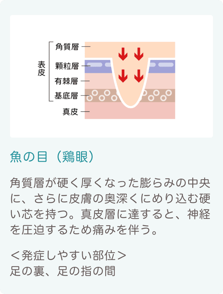 たこ・魚の目