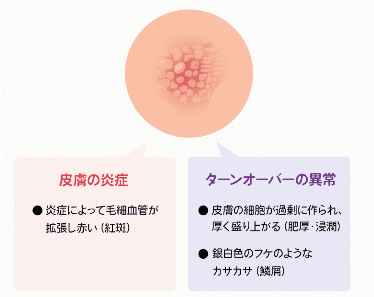 乾癬の治療