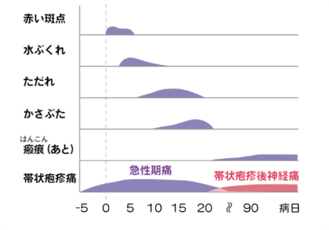 帯状疱疹の症状